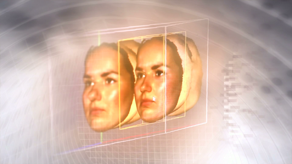 3d avşar mask rinoplasti, burun estetiği
