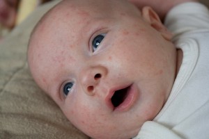 bebekte alerji