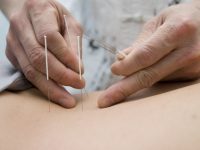 Doctor uses needles for treatment of the patient